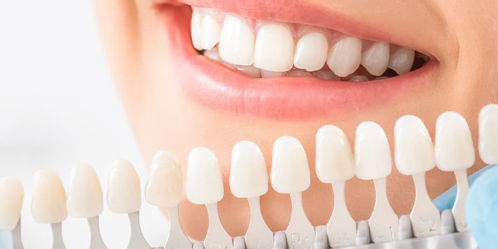 Everything You Need to Know About Dental Veneers