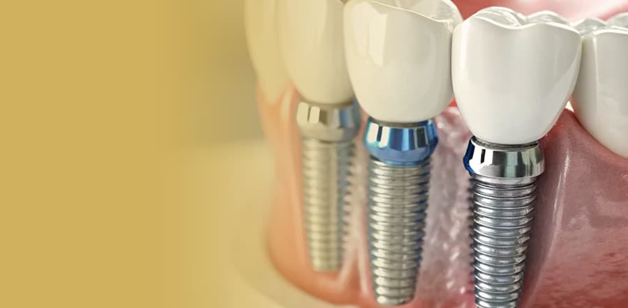 All-on-4 ve All-on-6 Sistemleri