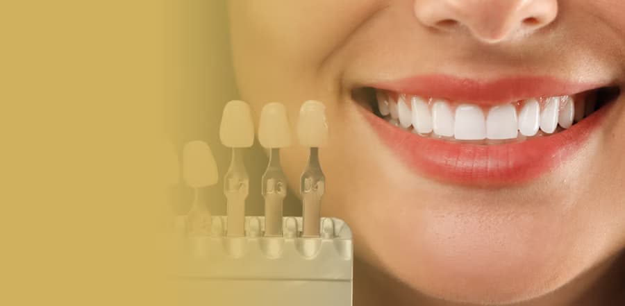 Porselen (Lamina) Kaplama